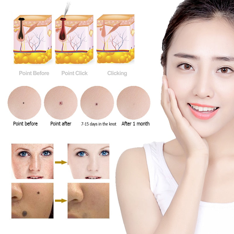 6 level Spot Remover Laser Plasma Pen Skin Care Mole Removal Dark Skin Wart Tattoo - Sabreeonline